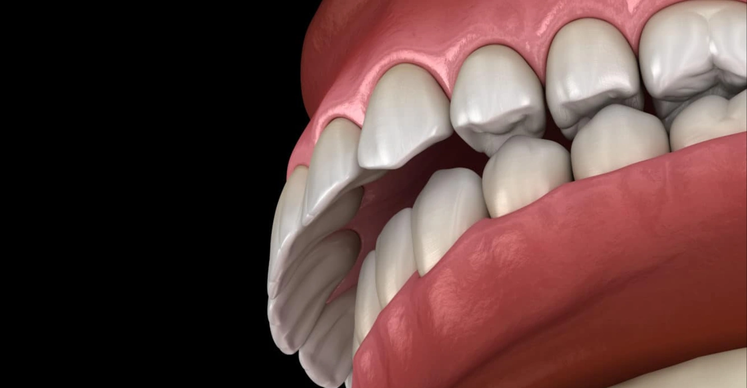 Malocclusion Inblog